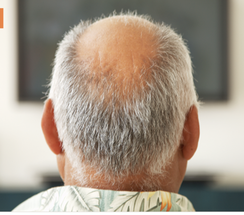 How to treat male pattern baldness